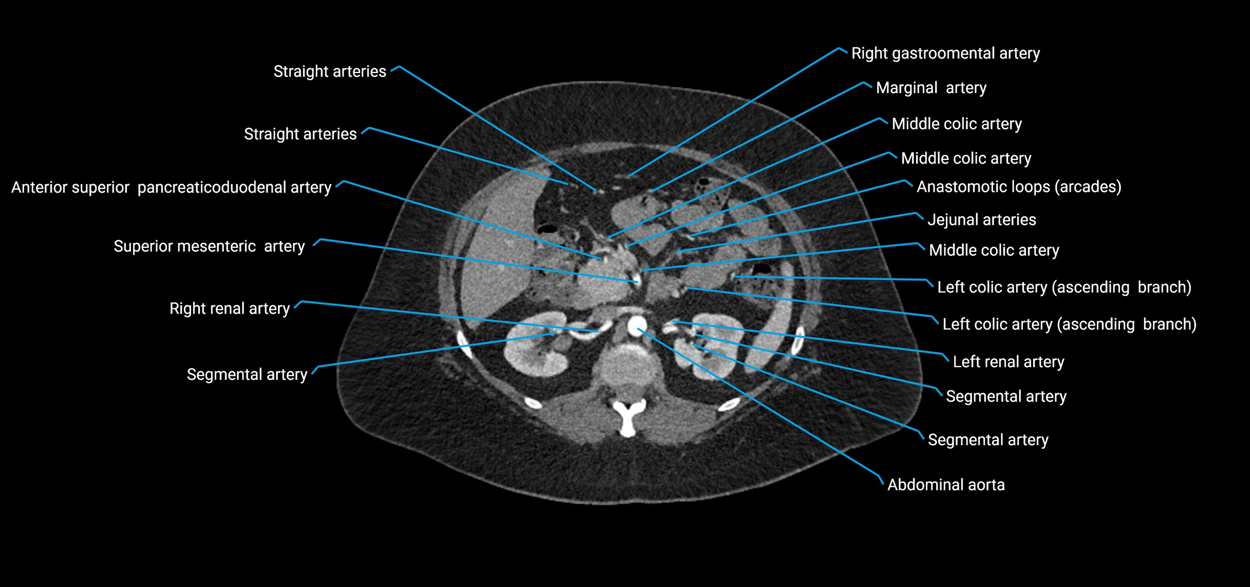 CTA abdomen axial cross sectional anatomy labelled image_70 (2).webp